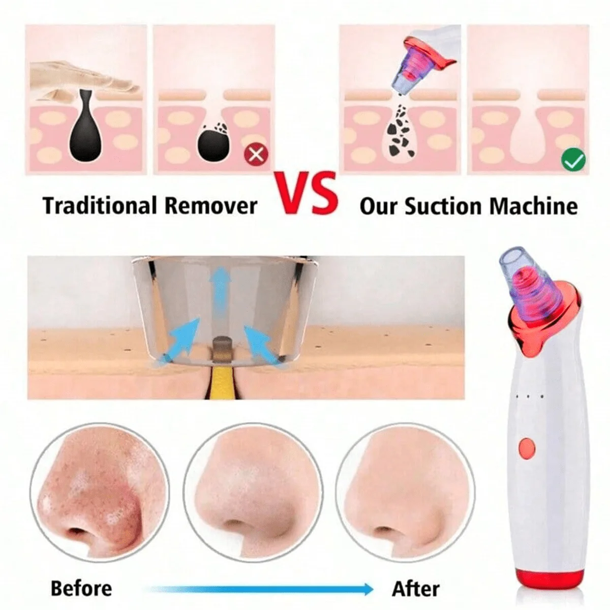 Blackhead Remover Vacuum Acne Pore Cleaner